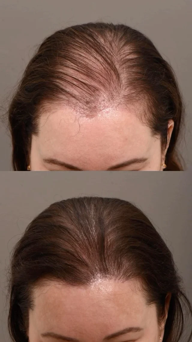 After five years of watching her hair thin, she was done working around it. No more strategic styling, no more hoping nobody notices — she was ready for a real solution.

She had the FUT procedure — a popular choice for women because longer hair naturally conceals the donor site. 2,200 grafts later, she’s on her way to having her hair back.

Female hair loss is more common than most people realize, and it deserves more than a “have you tried this shampoo?” conversation. Our team specializes in understanding what’s driving the loss and creating a plan that actually addresses it.

Grafts: 2,200
Surgeon: @drheatherlee