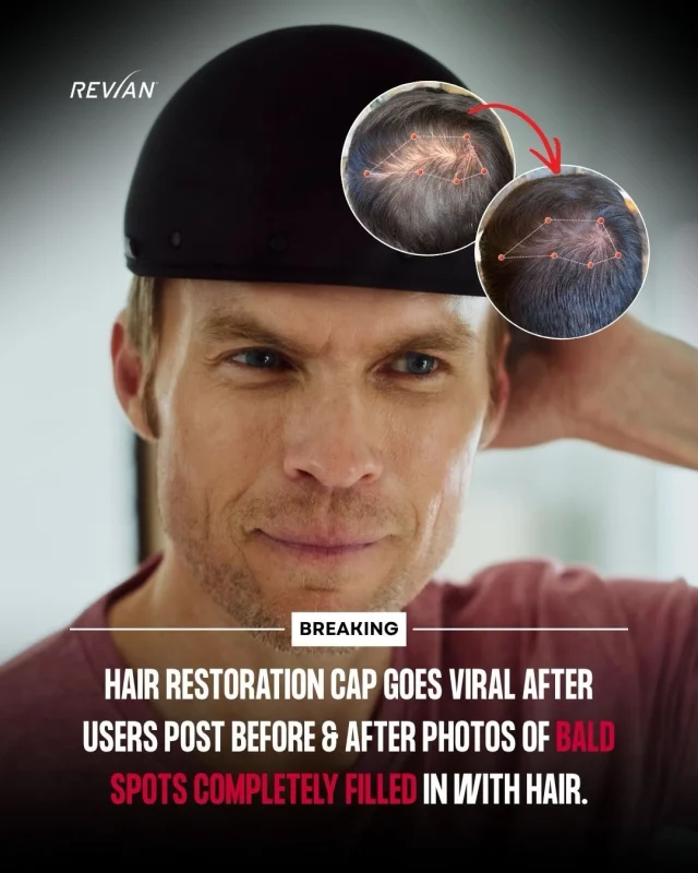 If you’ve started noticing your hair thinning, you don’t have to choose between doing nothing and doing surgery. 

Most men sit in that gap for years. We’d rather meet you there. 

We’re now offering the REVIAN Red Hair Growth System — an FDA-cleared, at-home device that uses light therapy to stimulate hair growth. No pills. No chemicals. No cords. Ten minutes a day. Results in as little as 16 weeks. 

Already on minoxidil or finasteride? REVIAN works alongside both — it’s designed to complement what you’re already doing, not replace it. 

It’s the kind of thing you can start now, while you still have hair worth protecting. Early intervention almost always leads to better outcomes — whether surgery ever enters the picture or not. 

Comment or DM us “GROWTH” for the link to purchase with our discount code!