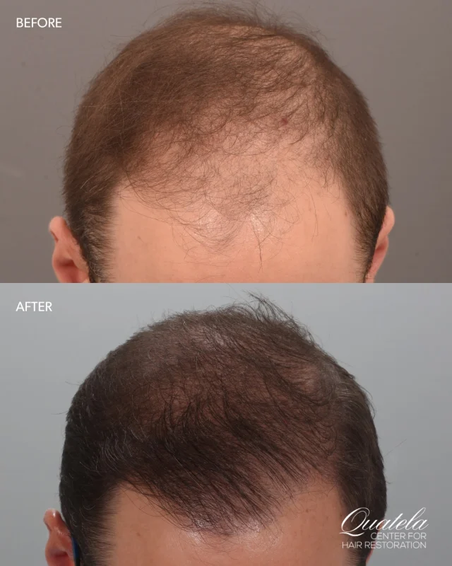 If you’ve been watching your hair thin for years and wondering if it’s too late — it’s not.

This patient came to @drheatherlee after 15 years of progressive hair loss. 1,600 FUE grafts later, and just over a year out, the results are exactly what we hoped for. He’s also started oral minoxidil and will be adding 82F to his routine to stay ahead of any future shedding.

Hair loss doesn’t have to be permanent. When you’re ready to do something about it, we’re here.

The first step is a consultation. Comment RESTORE to get started. 👇​​​​​​​​​​​​​​​​