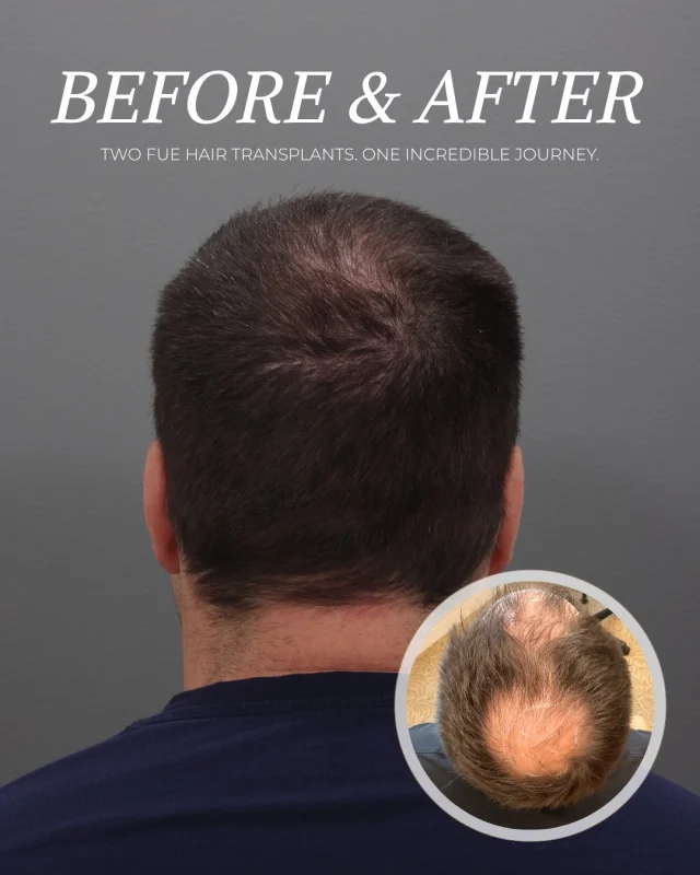If you’ve been considering a hair transplant, here’s what a long-term approach can look like.

This patient has androgenic alopecia and started his restoration journey with @dralexmontague — 1,800 grafts to restore the crown. The results were so good, he came back about 8 months later for 2,400 grafts along the frontal hairline. 

Alongside his transplants, he’s on minoxidil and 82F, and has added PRP injections to his routine — and he’s noticed a real difference across the board.

Now he’s looking at a third session to build even more density across the frontal, temporal, and crown areas.

This patient is doing everything right — combining surgical restoration with medical management, PRP, and a personalized treatment plan that works together as a whole. For those who want to take their results as far as possible, that comprehensive approach makes all the difference.

Comment RESTORE to start your consultation. 👇
