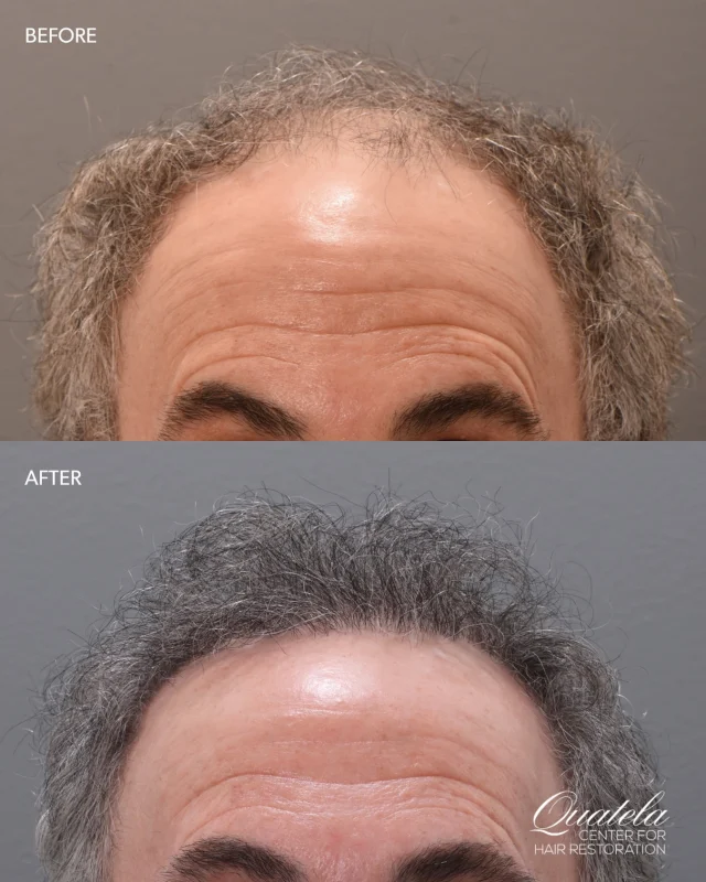 If you’ve been thinking about a hair transplant, this is your sign.

Nine months post-FUE with @drheatherlee — 1,800 grafts placed along the frontal hairline, and the growth is coming in beautifully. Full results hit at the one-year mark, and he’s already planning a second session to add even more density up front. 

This is what it looks like when you invest in the right team and trust the process.

Comment RESTORE to book your consultation. 👇