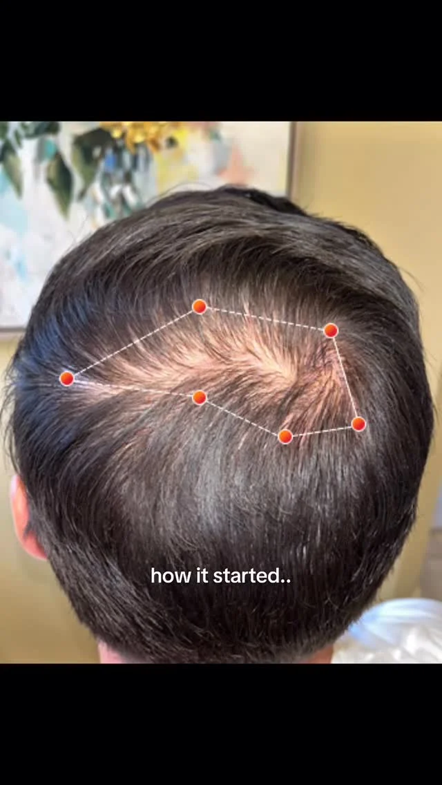 Crown density like this doesn’t happen by accident — it’s the result of consistent, clinically proven treatment. 

The REVIAN Cap uses FDA-cleared dual-wavelength light therapy, combining red (660nm) and orange (620nm) wavelengths to penetrate the scalp, reactivate dormant follicles, extend the growth phase, and inhibit DHT. Ten minutes a day. Wireless. No downtime.

Use it as a standalone therapy, stack it with finasteride or minoxidil, or integrate it post-transplant to protect existing hair and maximize graft survival. However it fits into your plan, it’s working.

Comment RED and we’ll send you an exclusive link to get $550 off your purchase.