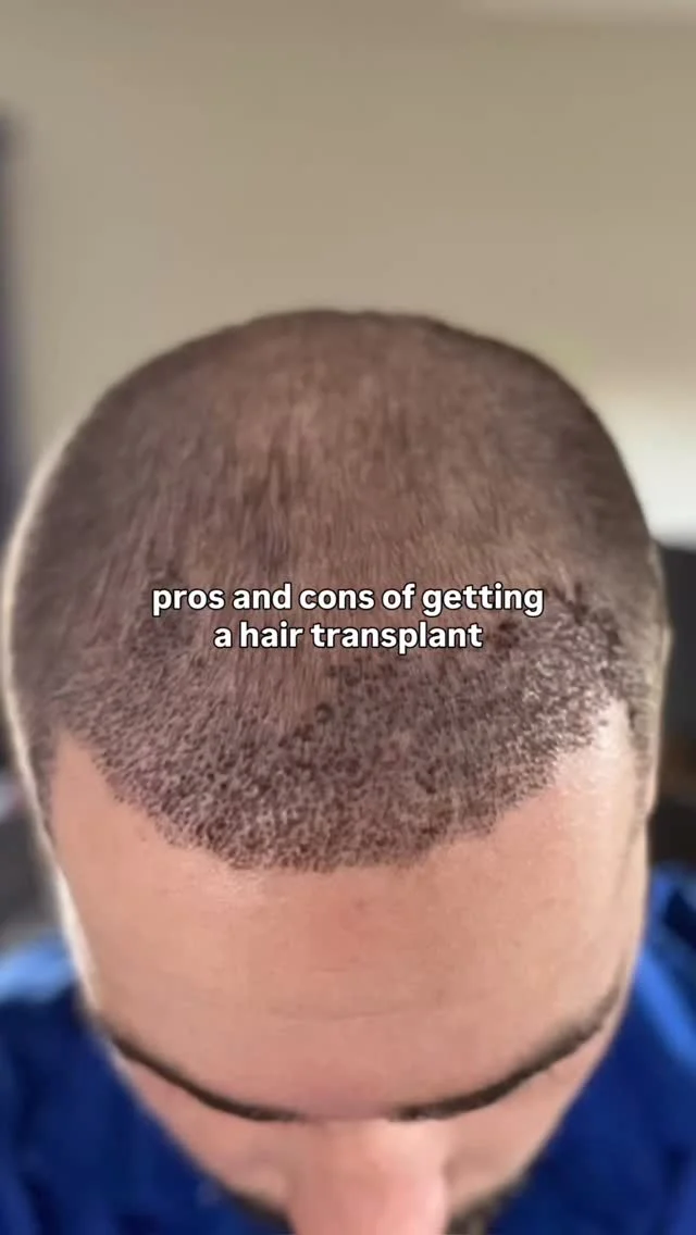 One of the biggest reasons people put off a hair transplant is because results aren’t instant. Real growth takes patience — usually several months before you start seeing major changes, and up to a year for full results.

But here’s the reality: that year is going to pass either way.
A year from now, you can still be thinking about making the change… or you can already be enjoying thicker, natural-looking hair and renewed confidence every time you look in the mirror.

Modern hair restoration is more advanced, natural, and undetectable than ever before. The hardest part for most patients isn’t the procedure — it’s finally deciding to start.

Your future self will thank you for not waiting.